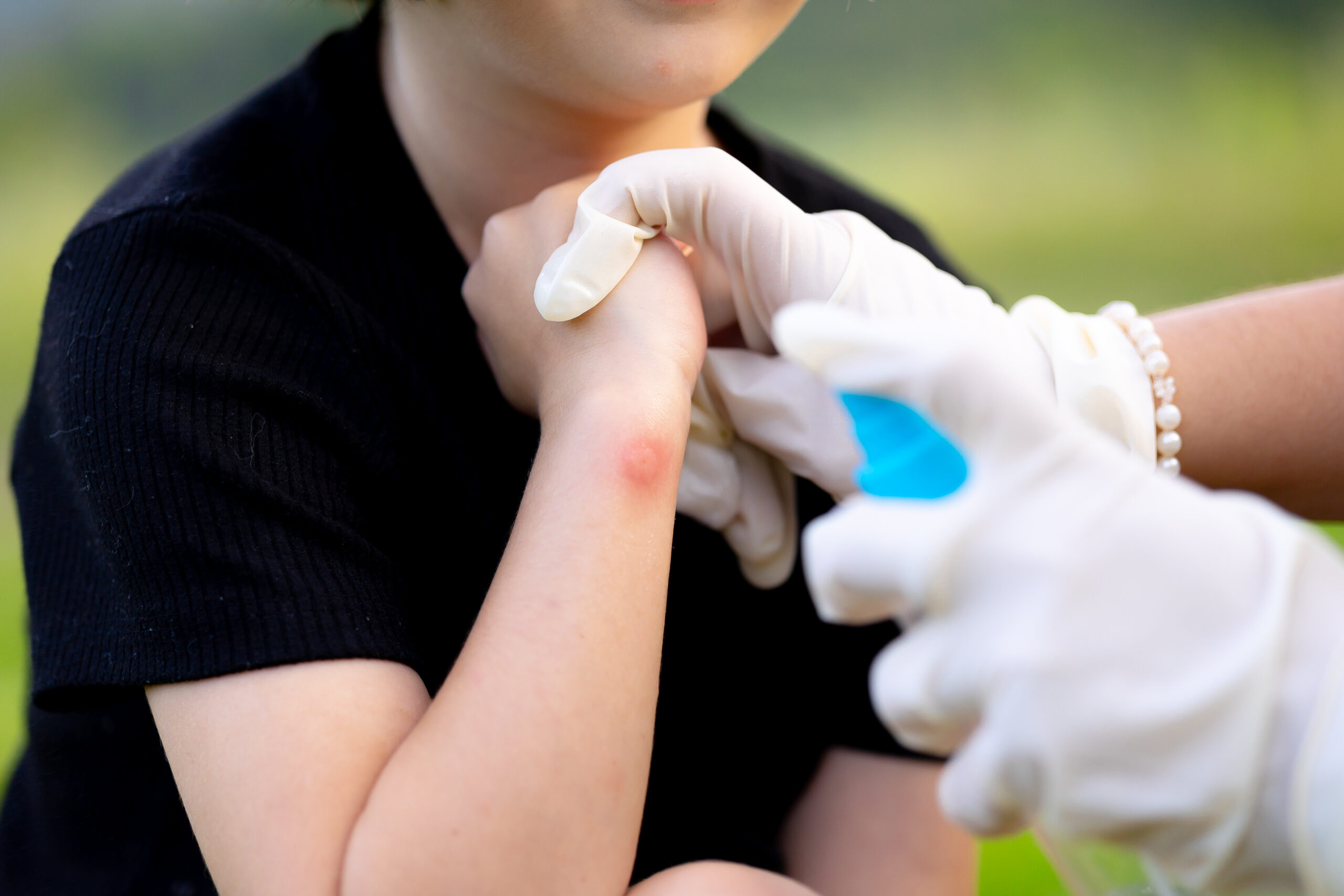 A healthcare provider wearing gloves sprays a solution on a child's arm, which has a red insect bite or skin irritation.